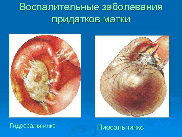 Воспалительные заболевания придатков матки Гидросальпинкс Пиосальпинкс Воспалительные заболевания придатков матки Гидросальпинкс Пиосальпинкс