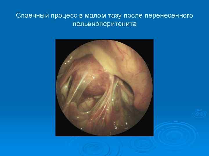 Спаечный процесс в малом тазу после перенесенного пельвиоперитонита Спаечный процесс в малом тазу после перенесенного пельвиоперитонита