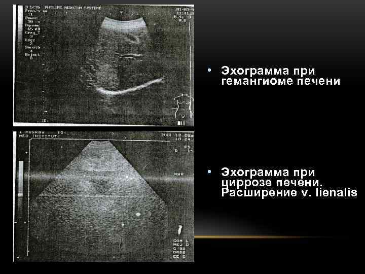  • Эхограмма при  гемангиоме печени • Эхограмма при  циррозе печени. 