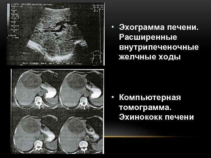  • Эхограмма печени.  Расширенные  внутрипеченочные  желчные ходы • Компьютерная 