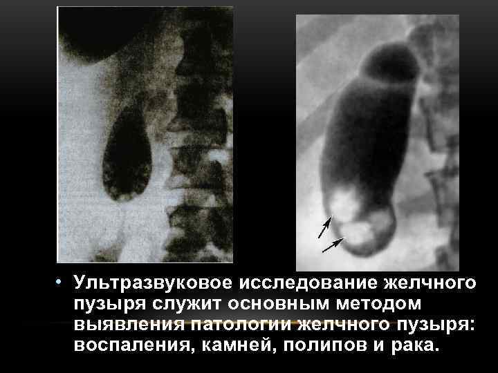 • Ультразвуковое исследование желчного  пузыря служит основным методом  выявления патологии желчного