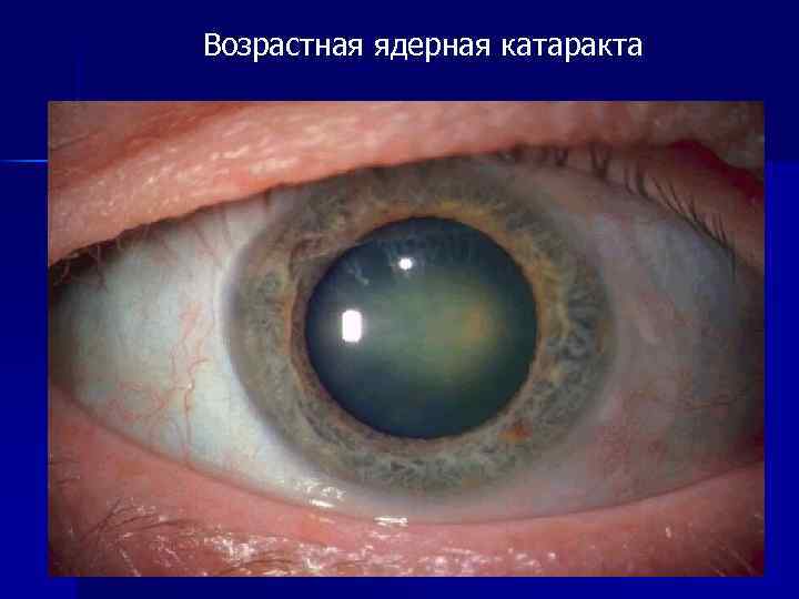 Возрастная ядерная катаракта 