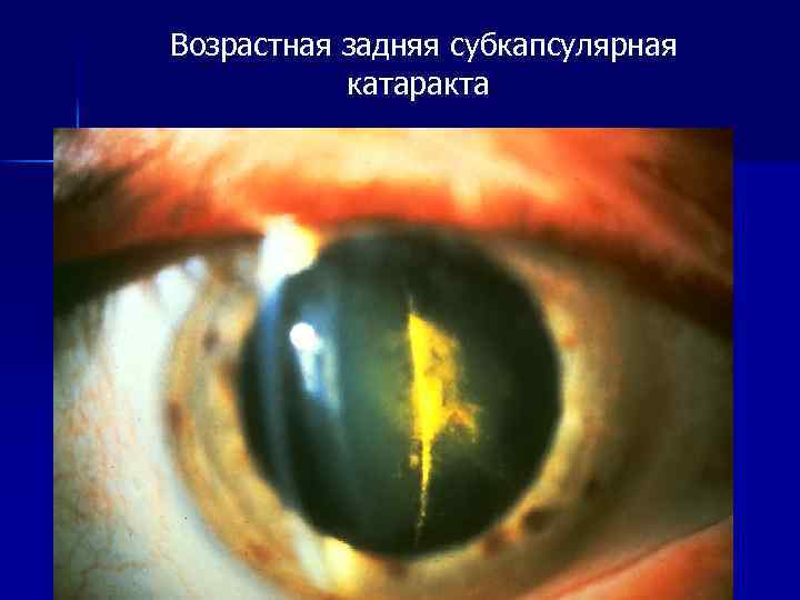 Возрастная задняя субкапсулярная катаракта 