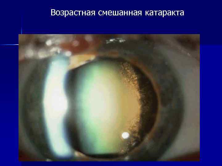 Возрастная смешанная катаракта 