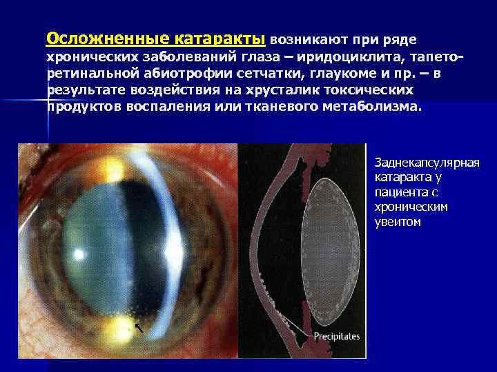 Катаракта картинки для презентации