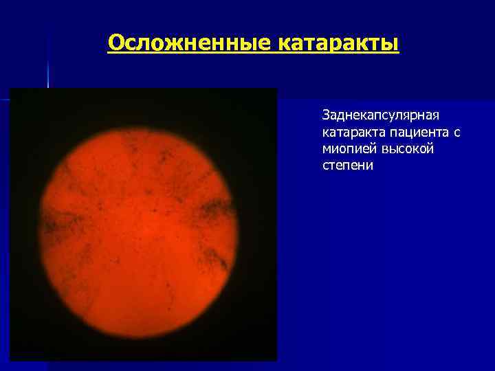 Осложненные катаракты Заднекапсулярная катаракта пациента с миопией высокой степени 