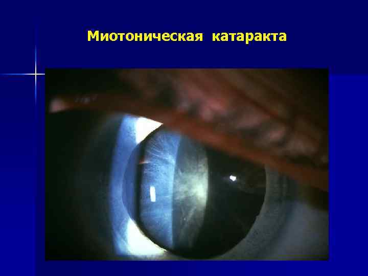 Миотоническая катаракта 