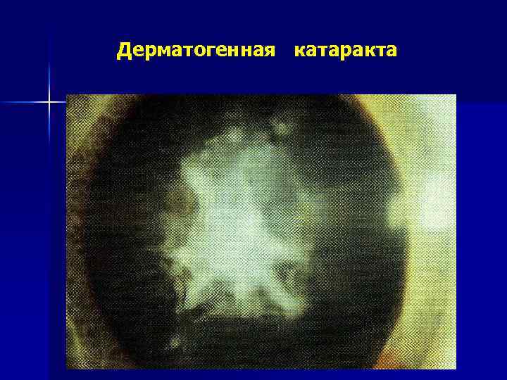 Дерматогенная катаракта 