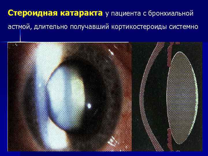 Стероидная катаракта у пациента с бронхиальной астмой, длительно получавший кортикостероиды системно 