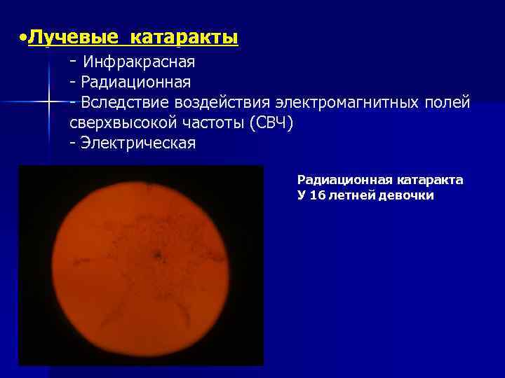  • Лучевые катаракты - Инфракрасная - Радиационная - Вследствие воздействия электромагнитных полей сверхвысокой