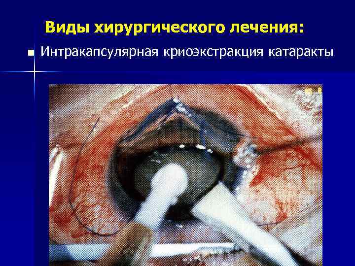 Виды хирургического лечения: n Интракапсулярная криоэкстракция катаракты 