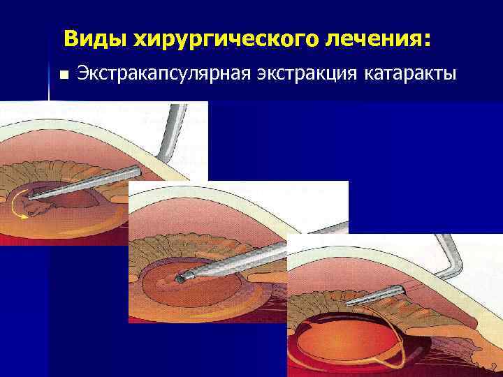 Виды хирургического лечения: n Экстракапсулярная экстракция катаракты 