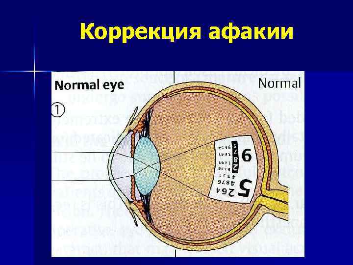 Коррекция афакии 