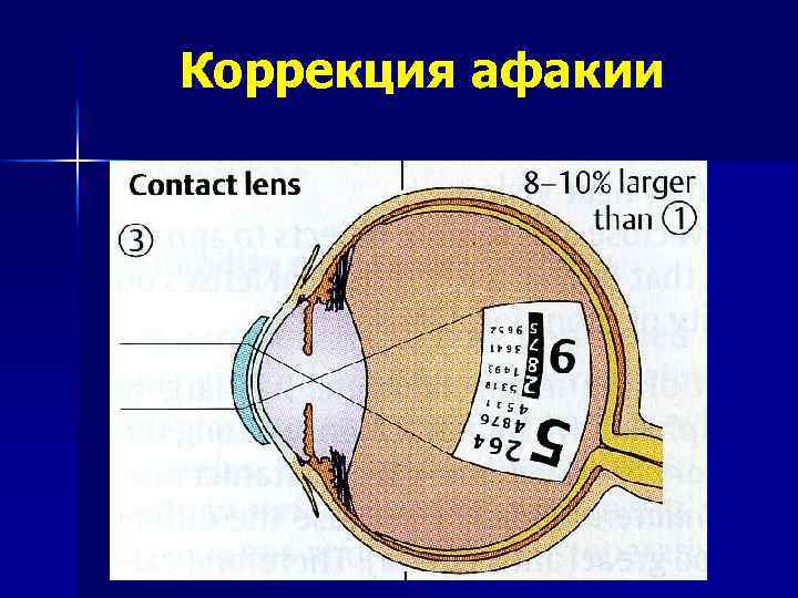 Афакия что это. Очковая коррекция афакии. Афакия и методы ее коррекции.