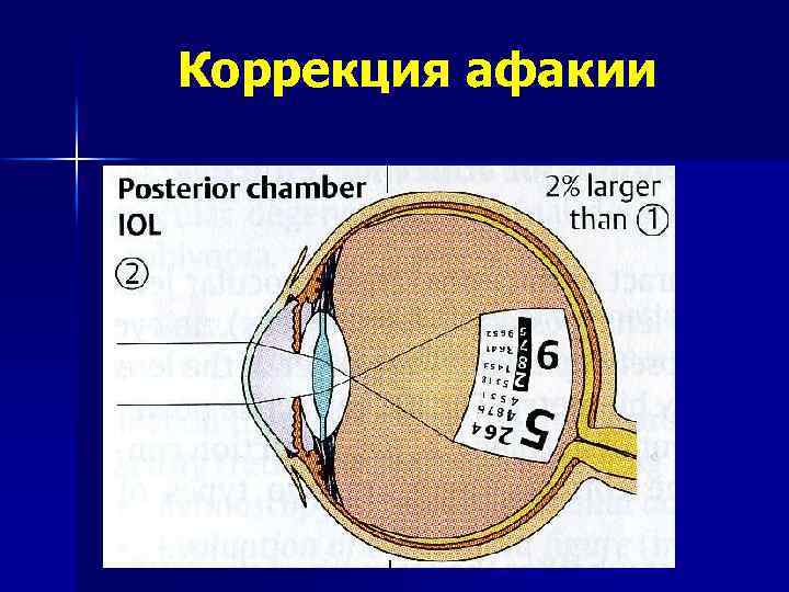 Коррекция афакии 