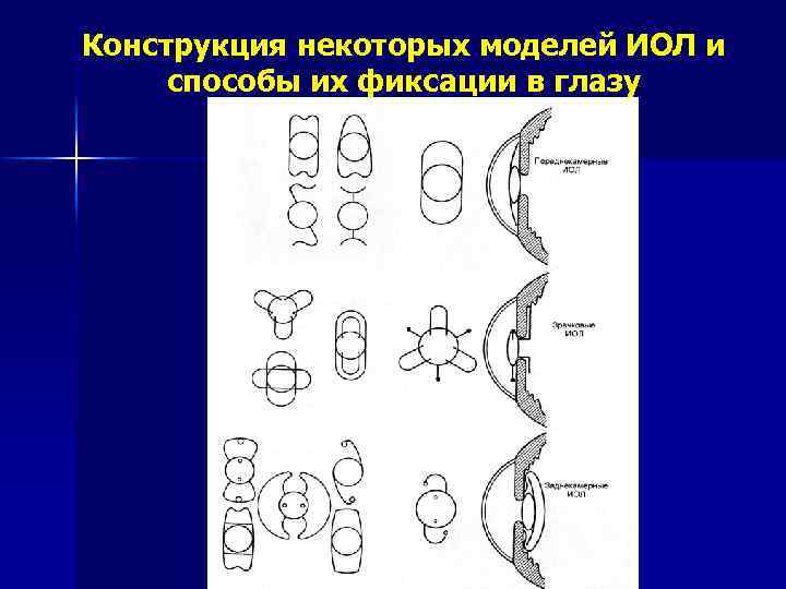 Конструкция некоторых моделей ИОЛ и способы их фиксации в глазу 