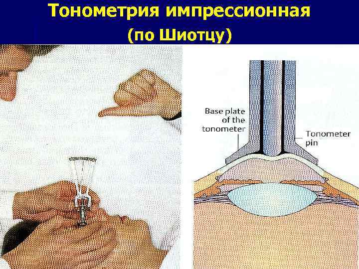 Тонометрия импрессионная (по Шиотцу) 