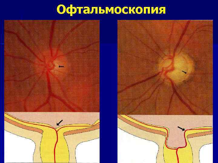 Офтальмоскопия 