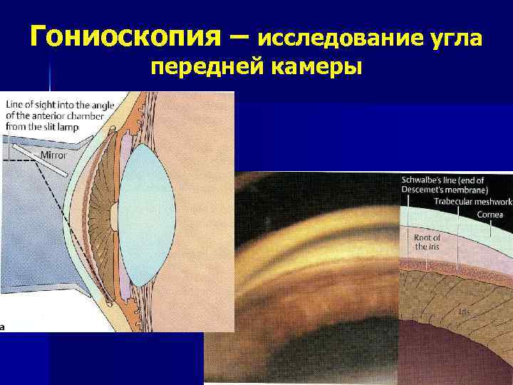 Гониоскопия глаукома. Угол передней камеры глаза при гониоскопии. Гониоскопия экзогенная пигментация.