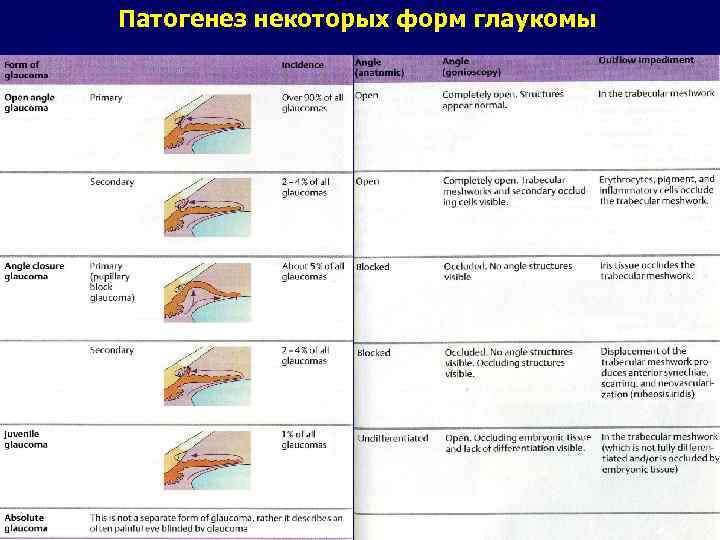 Патогенез некоторых форм глаукомы 