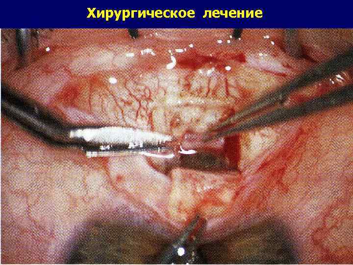 Хирургическое лечение 