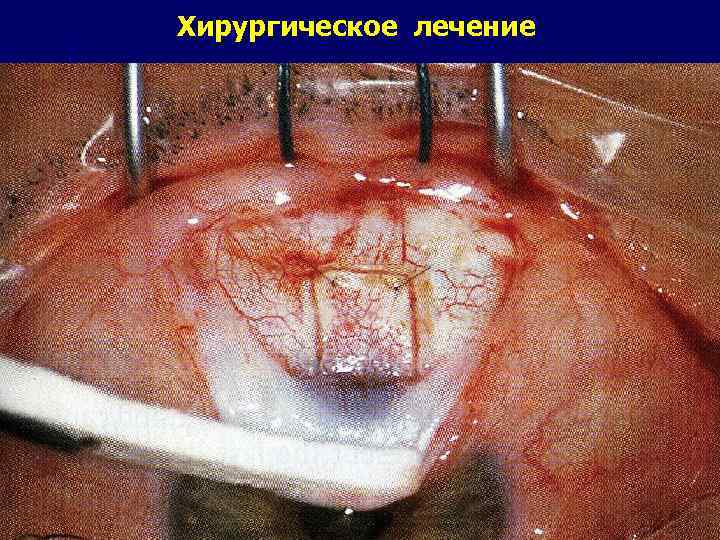 Хирургическое лечение 