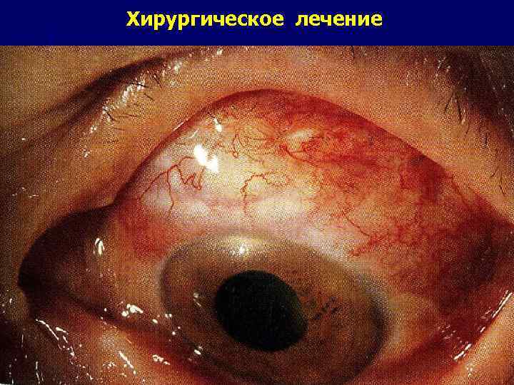 Хирургическое лечение 