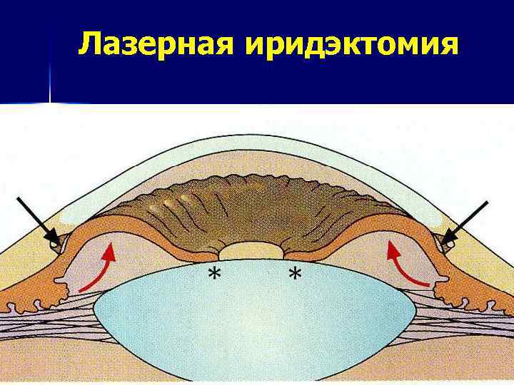 Лазерная иридэктомия. Периферическая лазерная иридотомия. Лазерная базальная иридэктомия. Лазерная иридотомия (иридэктомия).