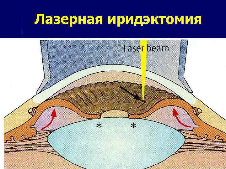 Лазерная иридэктомия 