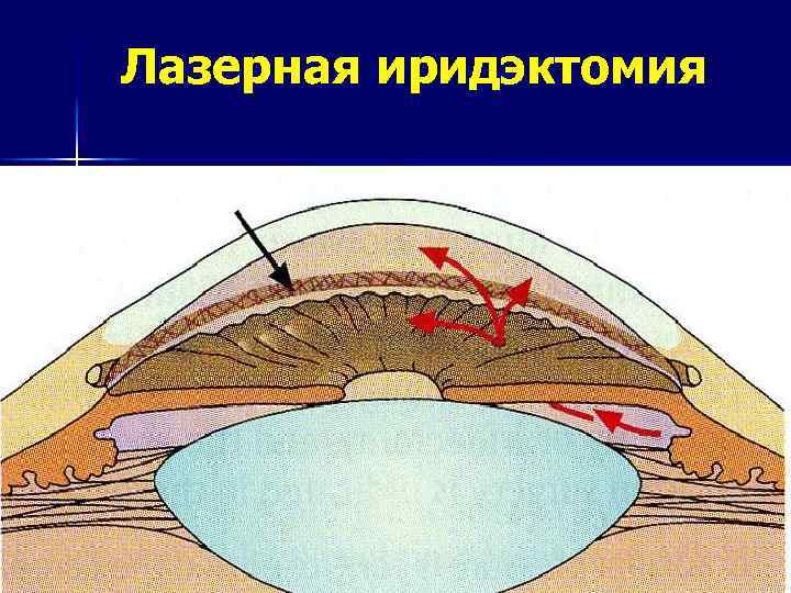 Лазерная иридэктомия 