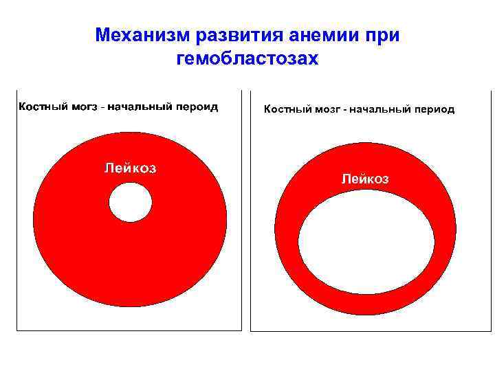 Механизм развития анемии при  гемобластозах   Костный мозг - начальный период 