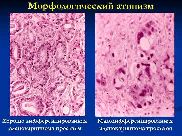 Тканевой атипизм рисунок