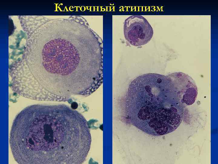 Клеточный атипизм опухоли