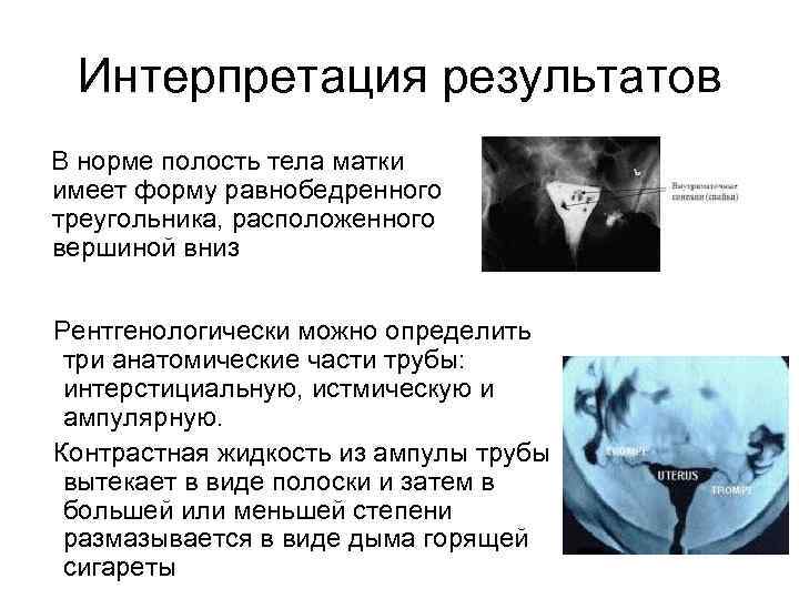  Интерпретация результатов В норме полость тела матки имеет форму равнобедренного треугольника, расположенного вершиной