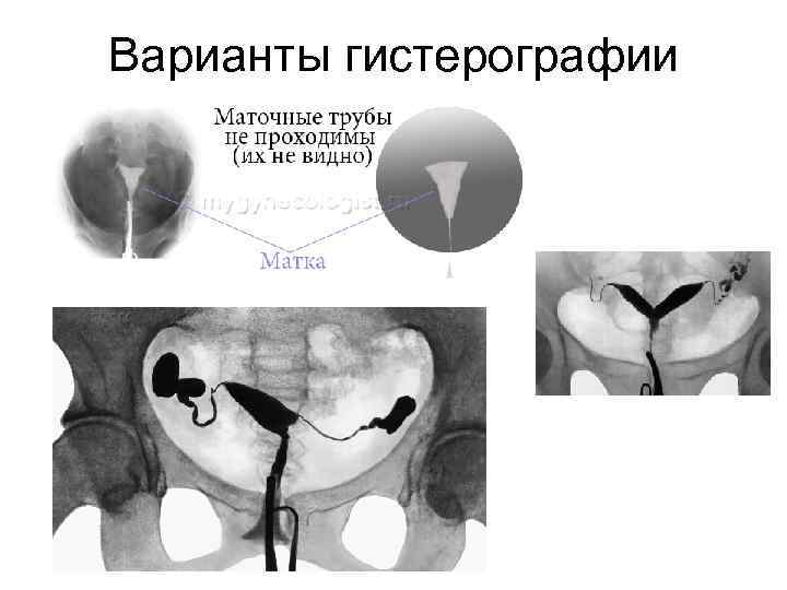 Варианты гистерографии 