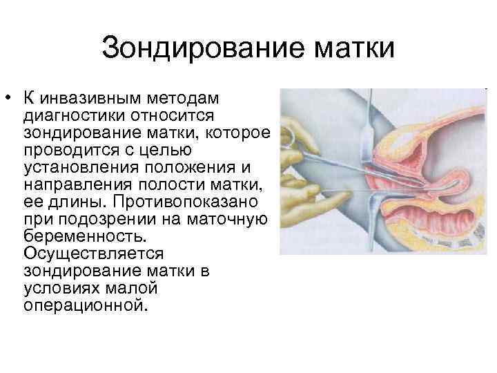    Зондирование матки • К инвазивным методам  диагностики относится  зондирование