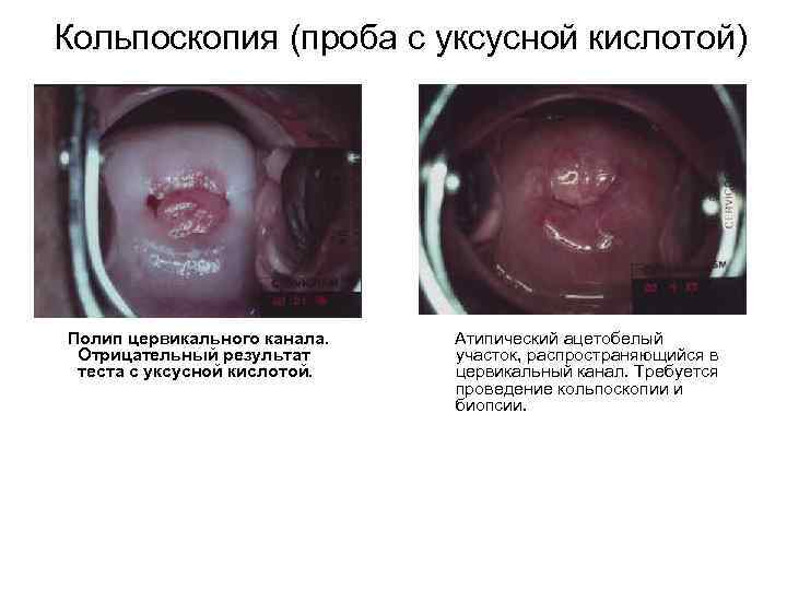 Кольпоскопия (проба с уксусной кислотой) Полип цервикального канала. Атипический ацетобелый  Отрицательный результат 
