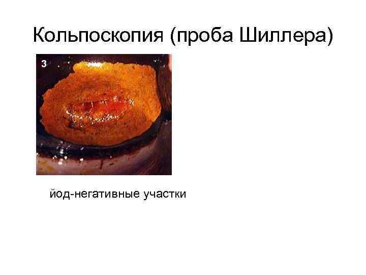 Кольпоскопия (проба Шиллера)  йод-негативные участки 