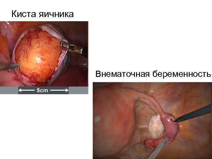 Киста яичника     Внематочная беременность 