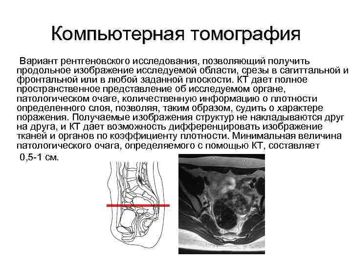    Компьютерная томография  Вариант рентгеновского исследования, позволяющий получить  продольное изображение