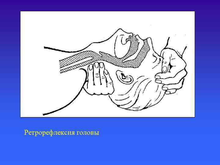 Ретрорефлексия головы 