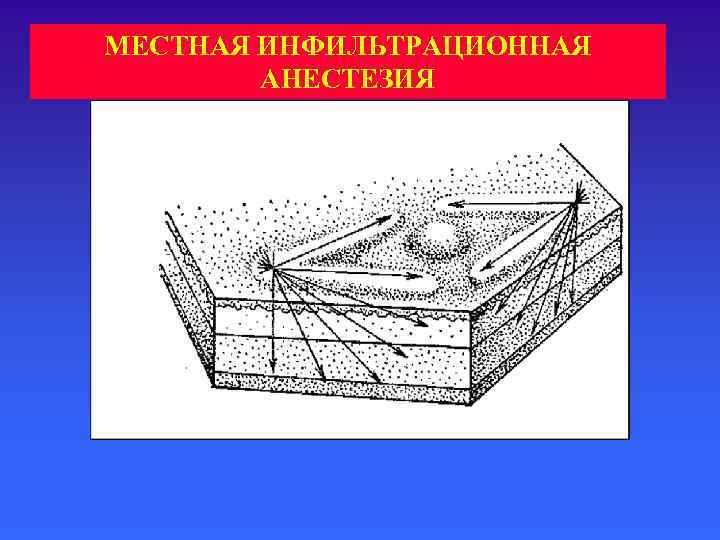 МЕСТНАЯ ИНФИЛЬТРАЦИОННАЯ   АНЕСТЕЗИЯ 