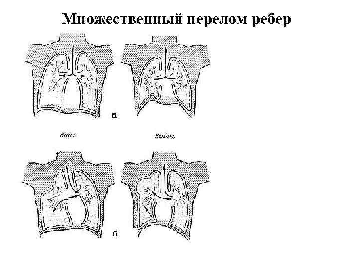 Множественные переломы ребер карта вызова