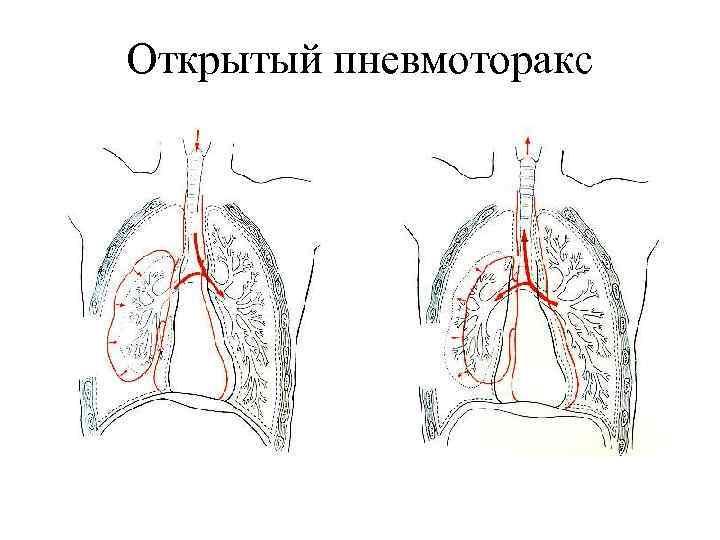 Клиническая картина открытого пневмоторакса