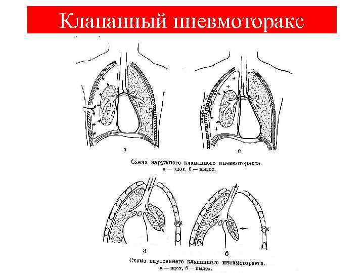 Клапанный пневмоторакс презентация