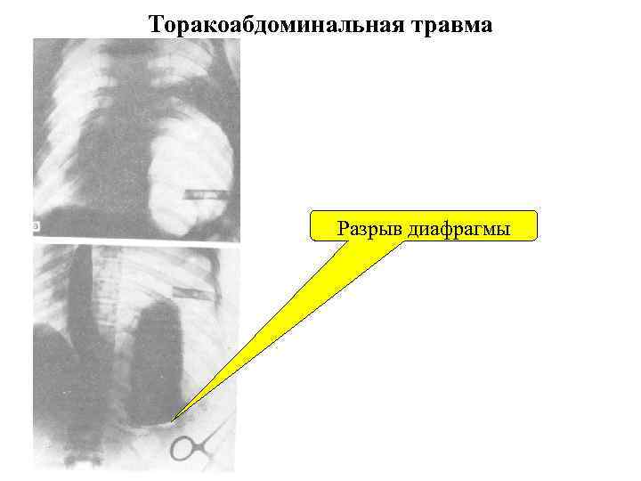 Торакоабдоминальные ранения презентация