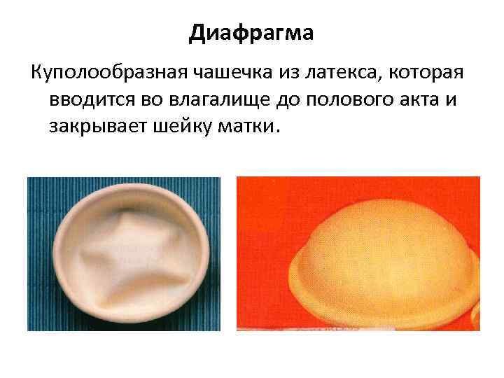    Диафрагма Куполообразная чашечка из латекса, которая  вводится во влагалище