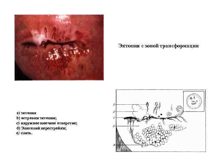        Эктопия с зоной трансформации а) эктопия b)