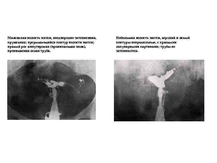 Маленькая полость матки, неоднородно затемненная, Небольшая полость матки, верхний и левый кружевная; прерывающийся контур
