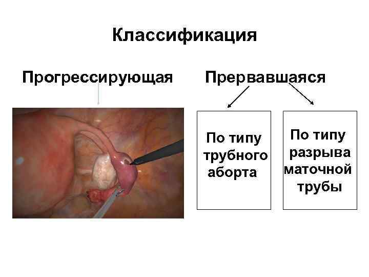   Классификация Прогрессирующая  Прервавшаяся     По типу  